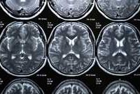 brain-scan